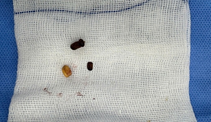 Hai hạt đậu xanh đã bung vỏ được lấy ra khỏi hai tai bé Hân. Ảnh: Bệnh viện Đa khoa Tâm Anh