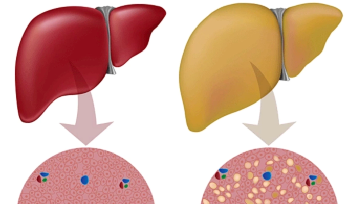Mô phỏng gan khỏe mạnh (trái) và gan nhiễm mỡ (phải). Ảnh: Healthline