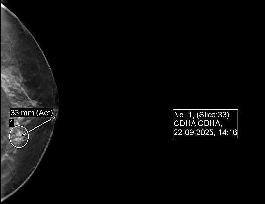 Ảnh tổn thương nghi ngờ ác tính mức độ trung bình. Ảnh: Bệnh viện Đa khoa Tâm Anh