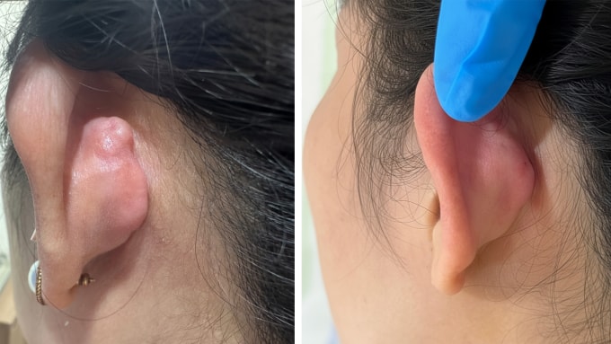 Phần sẹo lồi của chị Phương đã được thu nhỏ, xẹp dần sau 4 lần tiêm (phải). Ảnh: Bệnh viện Đa khoa Tâm Anh