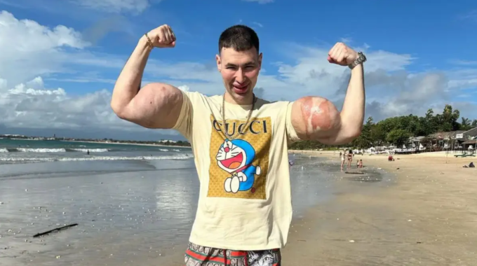 Kirill Tereshin tiêm synthol vào cánh tay để làm phồng cơ bắp. Ảnh: CEN