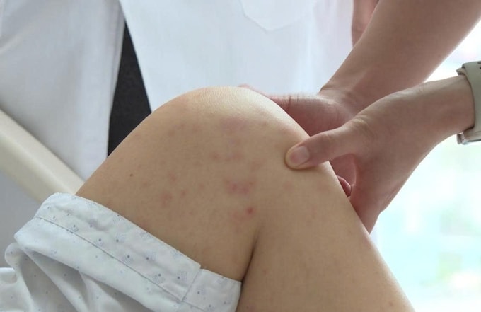 Bác sĩ Tâm kiểm tra tổn thương trên da của chị Lê trước xuất viện. Ảnh: Bệnh viện Đa khoa Tâm Anh