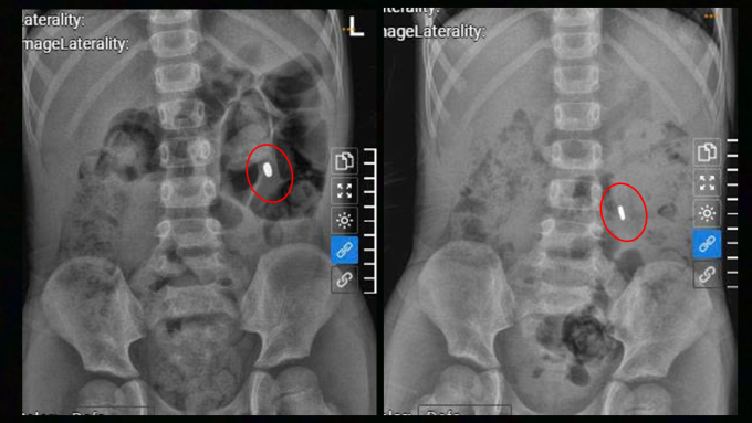 Khối nam châm trong bụng bệnh nhi trước và sau khi dùng thuốc nhuận tràng. Ảnh: Bệnh viện Đa khoa Tâm Anh
