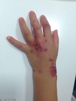 Xoắn khuẩn giang mai âm thầm xâm nhập não người bệnh- Ảnh 4.