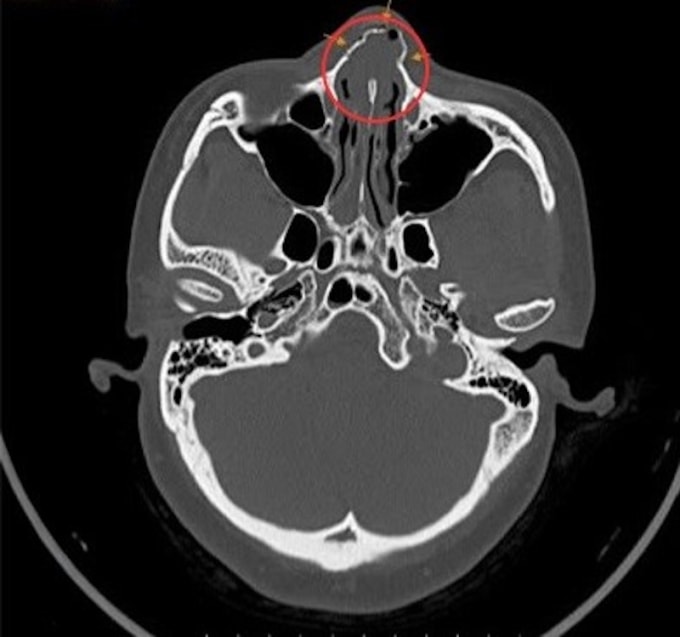 Kết quả chụp CT cho thấy di lệch tháp mũi, xương mũi gãy thành nhiều mảnh. Ảnh: Bệnh viện Đa khoa Tâm Anh