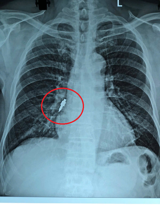 Đi khám răng về người đàn ông ho dữ dội, bác sĩ phát hiện bí mật "đáng sợ" bên trong - Ảnh 1.