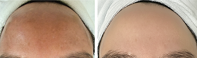 Sau một năm điều trị, vùng da sạm đen của chị Hồng sáng hồng (bên phải). Ảnh: Bệnh viện Đa khoa Tâm Anh