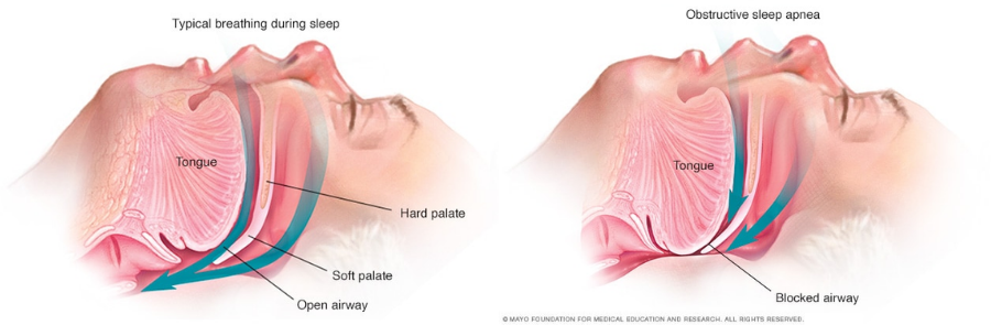 Ngưng thở khi ngủ do tắc nghẽn (OSA)