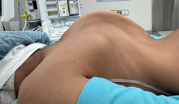 Góc cong vẹo cột sống của bé Tuyết trước mổ. Ảnh: Bác sĩ cung cấp