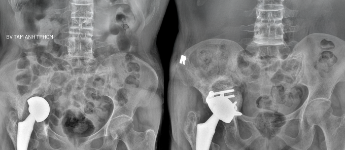 Khớp háng nhân tạo của bà Nga trước phẫu (trái) đi sâu vào trong khung chậu và sau khi phẫu thuật lần hai. Ảnh: Bệnh viện Đa khoa Tâm Anh