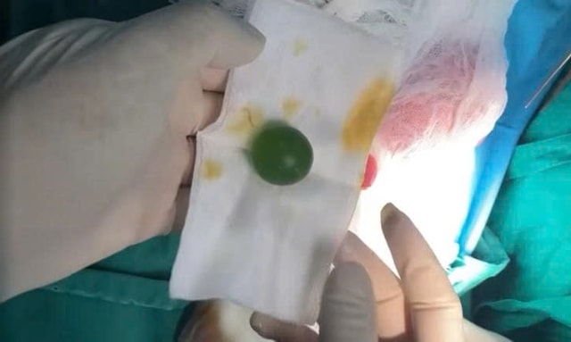 Bé13 tháng tuổi ăn gì nôn đấy, bác sĩ gắp ra thứ "đáng sợ" - Ảnh 1.