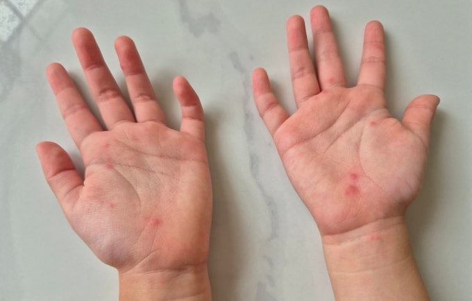 Trẻ mắc tay chân miệng. Ảnh: Lê Phương