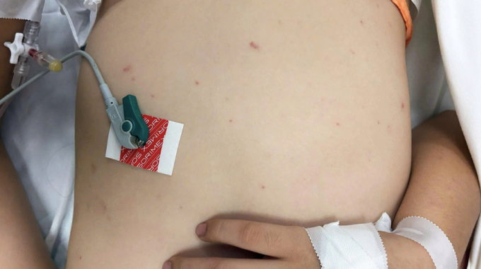 Trẻ mắc não mô cầu điều trị tại Bệnh viện TP Thủ Đức, TP HCM. Ảnh:Bệnh viện cung cấp