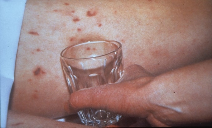 Tử ban do bệnh não mô cầu, không mất khi ấn ly trong suốt vào. Ảnh: Meningitis Research Foundation