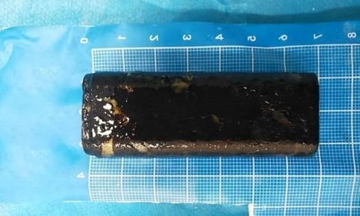 Người đàn ông đau bụng dữ dội, bác sĩ gắp ra thứ "đáng sợ" - Ảnh 1.