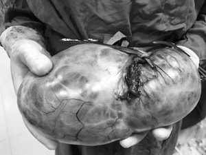 Khối u buồng trứng khổng lồ chiếm gần trọn bụng dưới của bệnh nhân 20 tuổi- Ảnh 3.