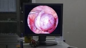 Khối u buồng trứng khổng lồ chiếm gần trọn bụng dưới của bệnh nhân 20 tuổi- Ảnh 4.