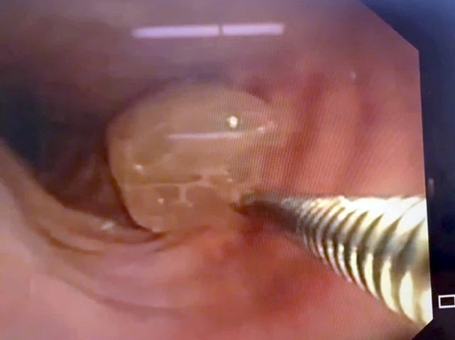 Người đàn ông 62 tuổi nguy kịch vì sặc nửa trái nho xanh - Ảnh 1.