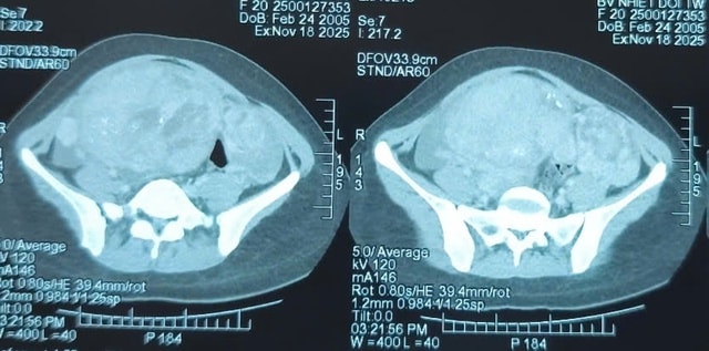 Khối u buồng trứng khổng lồ chiếm gần trọn bụng dưới của bệnh nhân 20 tuổi- Ảnh 1.