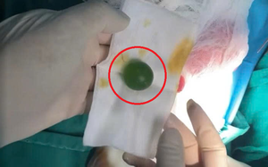 Người đàn ông 62 tuổi nguy kịch vì sặc nửa trái nho xanh - Ảnh 3.