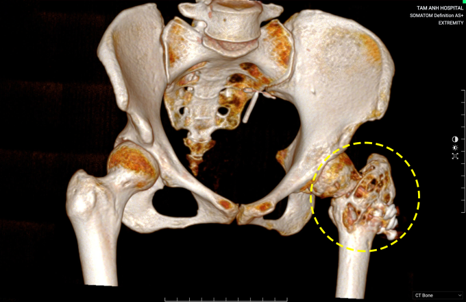 Ảnh chụp CT cho thấy chỏm đùi trái chị Lan tiêu xương nặng do u tế bào khổng lồ. Ảnh: Bệnh viện Đa khoa Tâm Anh