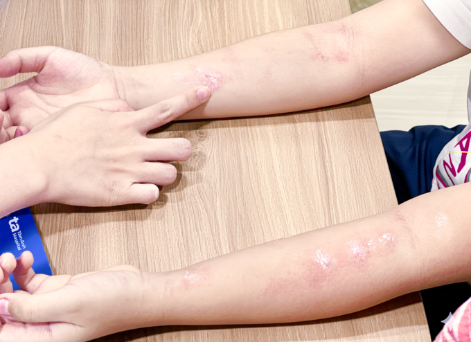 Hai tay của bé Đăng phản ứng nổi mề đay sau khi xét nghiệm lẩy da với các yếu tố dị ứng. Ảnh: Bệnh viện Đa khoa Tâm Anh