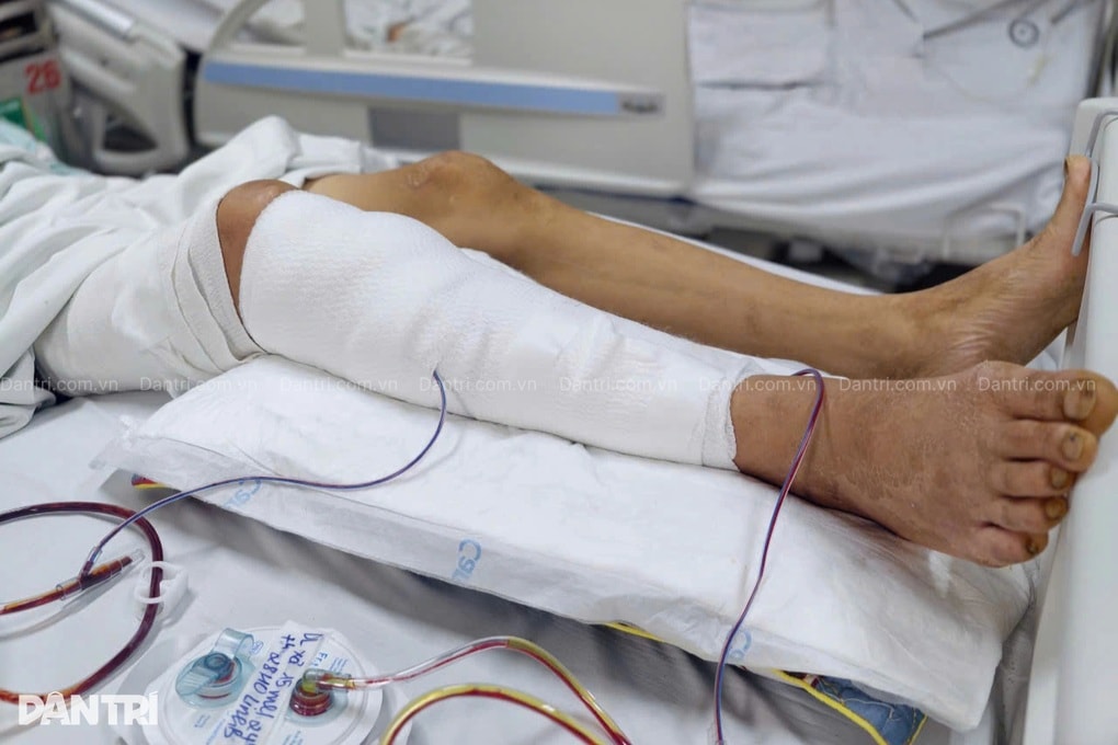 Dập nát chân do cuốn vào máy gặt, người bố 3 con xin “cắt chân cho đỡ khổ” - 2