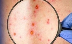 Đồng Nai ghi nhận ca mắc đậu mùa khỉ chưa rõ nguồn lây- Ảnh 1. Đồng Nai ghi nhận ca mắc đậu mùa khỉ chưa rõ nguồn lây- Ảnh 1.