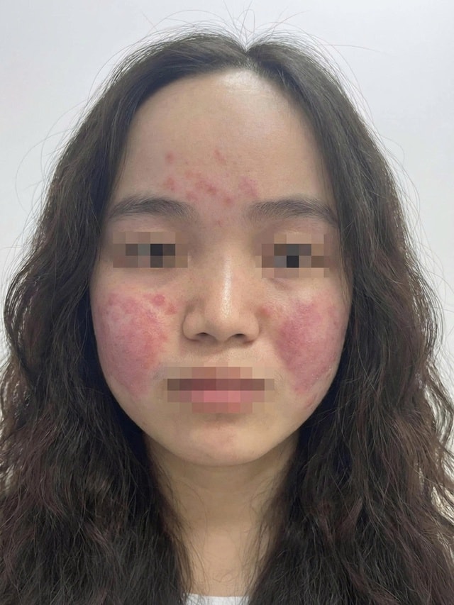 Tiếp xúc ô nhiễm không khí, chuyên gia cảnh báo gia tăng bệnh về da- Ảnh 2.