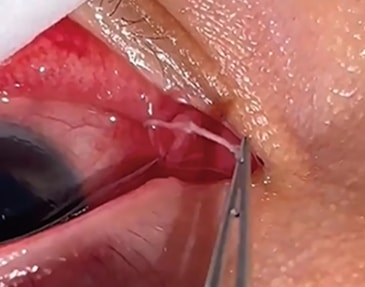 Người phụ nữ đau mắt đi khám, bác sĩ gắp ra thứ "đáng sợ" bên trong- Ảnh 1.