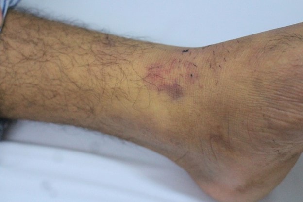 Bị rắn cắn, người đàn ông nguy kịch do tự đắp thuốc để "hút độc"- Ảnh 1.