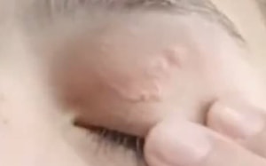 Người phụ nữ đau mắt đi khám, bác sĩ gắp ra thứ "đáng sợ" bên trong- Ảnh 3.