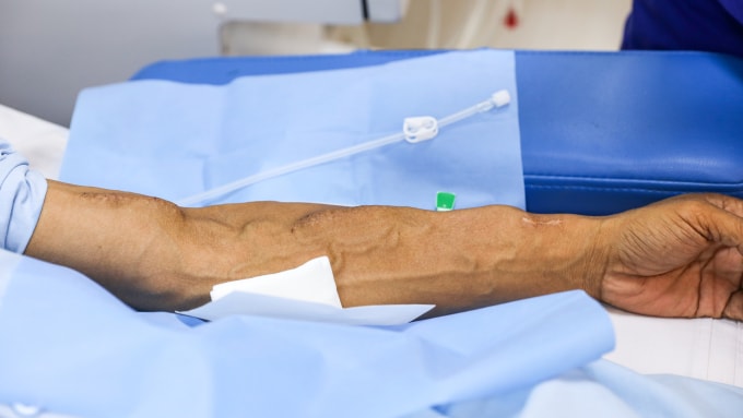 Bệnh nhân chạy thận nhân tạo tại Bệnh viện Thống Nhất, TP HCM. Ảnh: Phùng Tiên