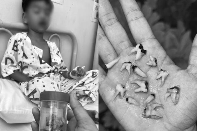 Thói quen bú bình khi ngủ và vệ sinh răng miệng kém khiến cậu bé bị sâu răng, phải nhổ 12 cái một lúc. Ảnh: Facebook Siti Nur Haiza