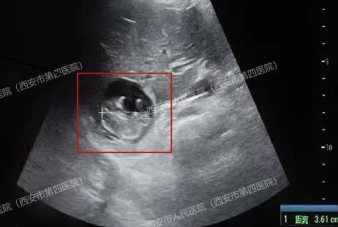 Ca phẫu thuật khẩn cấp để loại bỏ khối thai và một phần mô gan bị ảnh hưởng của Wang tại Bệnh viện Nhân dân Tây An. Ảnh: Qidian News