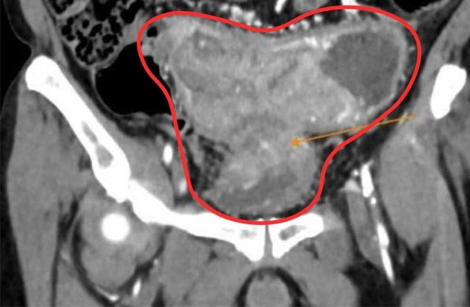 Khối u ác tính gây hẹp hoàn toàn lòng ruột gây dãn ứ phân, xâm lấn gây dày thành bàng quang. Ảnh: Bệnh viện Đa khoa Tâm Anh