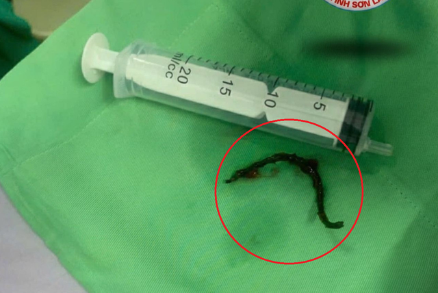 Người phụ nữ đau họng không chịu nổi, bác sĩ gắp ra thứ "đáng sợ" - Ảnh 1.