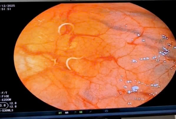 Món vạn người mê đưa ổ giun vào bụng người phụ nữ - Ảnh 1.