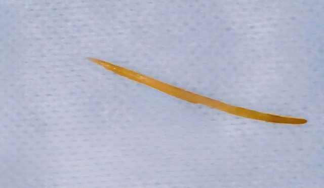 Người đàn ông 57 tuổi đau bụng thốc ngược lên, bác sĩ gắp ra thứ "đáng sợ" dài 5cm- Ảnh 1. Người đàn ông 57 tuổi đau bụng thốc ngược lên, bác sĩ gắp ra thứ "đáng sợ" dài 5cm- Ảnh 1.