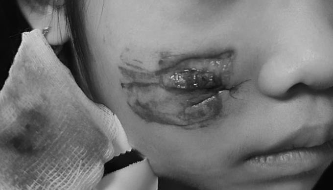 Vết thương trên khuôn mặt bé gái do khỉ cắn. Ảnh: Bệnh viện cung cấp