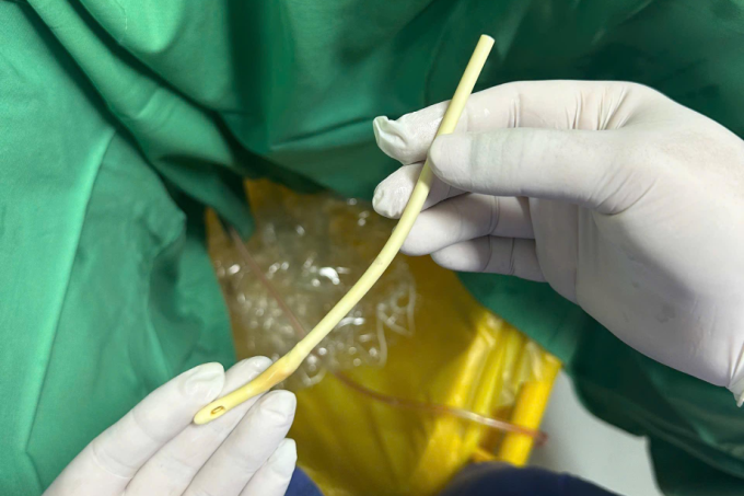 Chiếc ống xông bị bệnh nhân cắt. Ảnh: Bệnh viện cung cấp