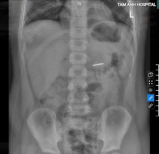 Phim chụp X-quang xác định khối nam châm trong dạ dày bệnh nhi. Ảnh: Bệnh viện cung cấp