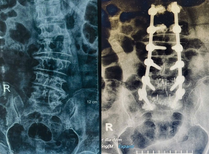 Phim chụp X-quang trước (trái) và sau phẫu thuật bắt vít điều chỉnh cong vẹo cột sống của một người bệnh cao tuổi. Ảnh: Bệnh viện Đa khoa Tâm Anh