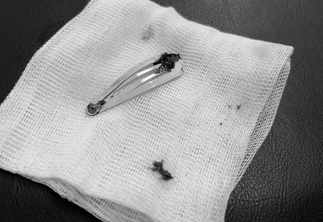 Bé gái 6 tuổi được cô giáo đưa đến viện, bác sĩ gắp thứ dài 7cm trong bụng - Ảnh 1.