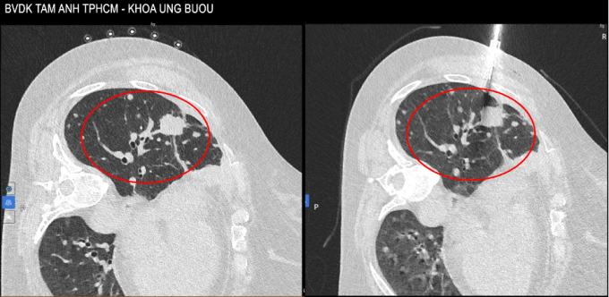 Hình ảnh CT vào tháng 10/2025 thấy u tăng kích thước lên 4 cm và các tổn thương rải rác xung quanh. Ảnh: Bệnh viện Đa khoa Tâm Anh