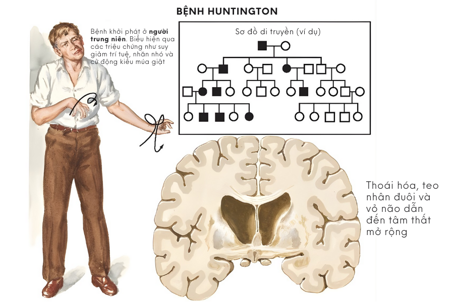 Bệnh Huntington gây rối loạn vận động