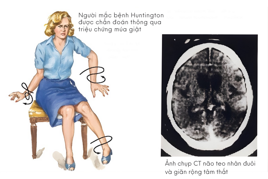 chẩn đoán bệnh Huntington