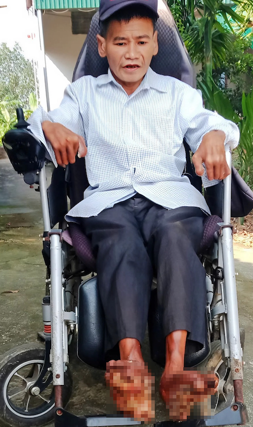Anh Sơn trên xe lăn tại nhà. Ảnh: Sơn Nguyễn