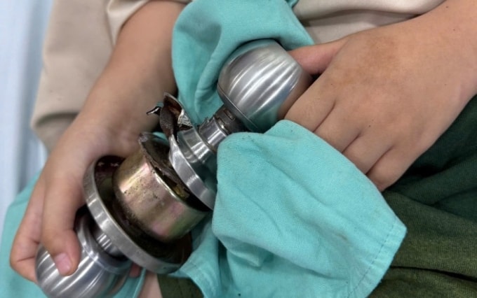 Bệnh nhi đến viện với ngón tay cái kẹt trong ổ khóa. Ảnh: Bệnh viện cung cấp