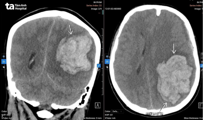 Đột quỵ ở tuổi 22